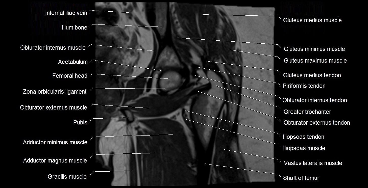 MRI Hip 3T coronal cross sectional anatomy image 38.webp